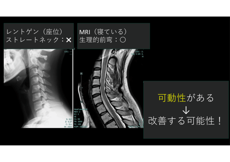 リハビリと努力で姿勢改善→頚部痛改善のアイキャッチ画像