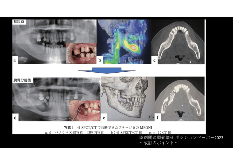 骨粗しょう症治療薬による顎骨壊死についてのアイキャッチ画像