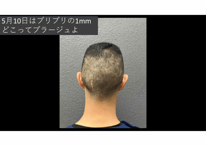 「腰椎椎間関節リゾトミー」30年来の腰痛が治った　70代男性のアイキャッチ画像