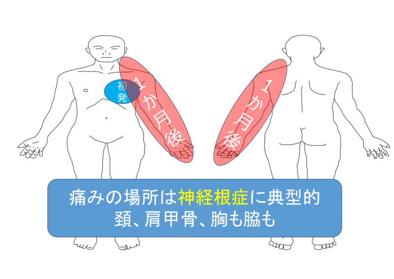 胸痛で発症した頚椎椎間板ヘルニアのアイキャッチ画像
