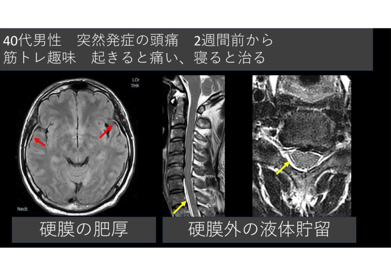 脳せき髄液減少症のアイキャッチ画像