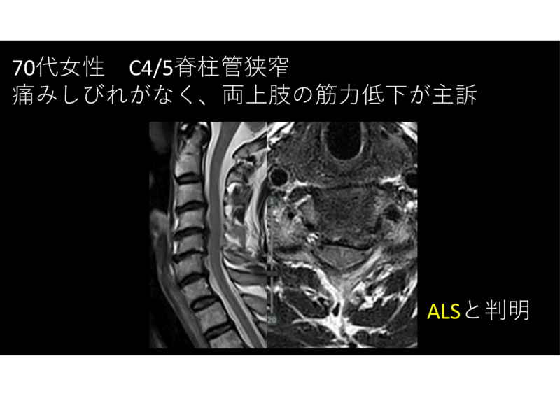 痛みしびれのない筋力低下はALSを疑えのアイキャッチ画像