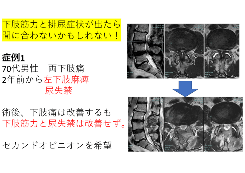 腰部脊柱管狭窄症と排尿障害　除圧が間に合った人と遅かった人のアイキャッチ画像