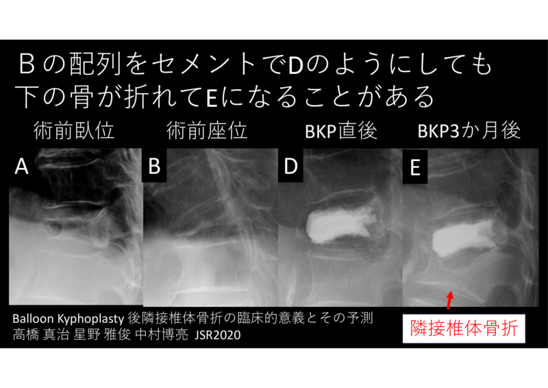 圧迫骨折の治療法 BKPセメント手術後の続発性骨折についてのアイキャッチ画像