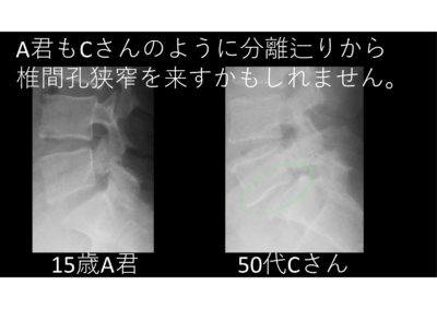 腰椎分離が完成すると→分離辷り→椎間孔狭窄→腰痛と下肢のしびれのアイキャッチ画像