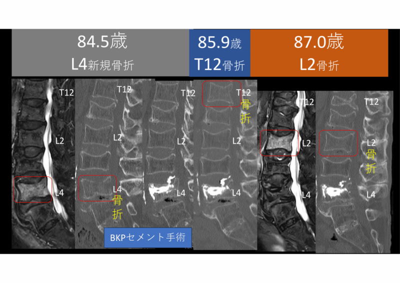 骨形成促進薬を導入されず、3年連続で年1個ずつ圧迫骨折を繰り返しているご婦人のアイキャッチ画像