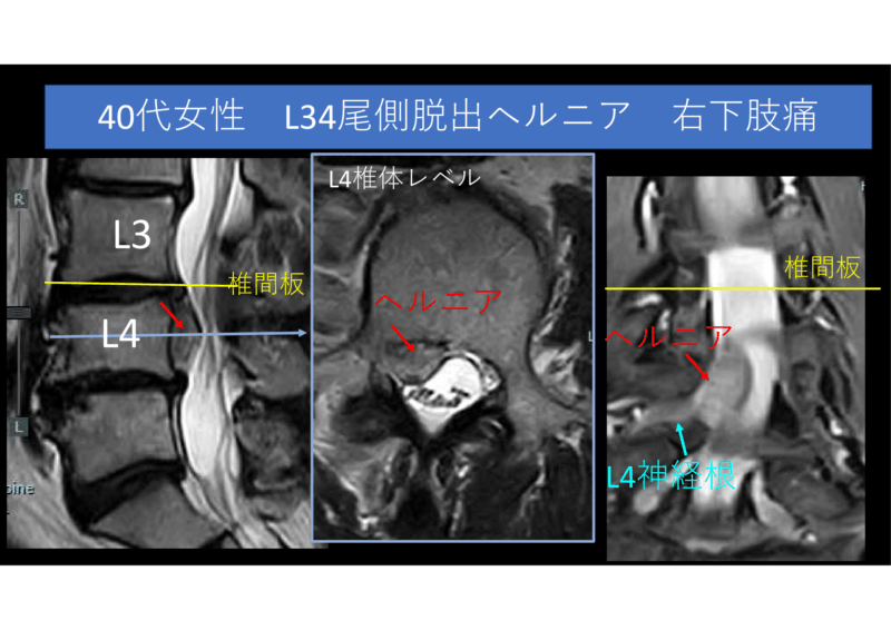 尾側脱出型腰椎椎間板ヘルニアのアイキャッチ画像