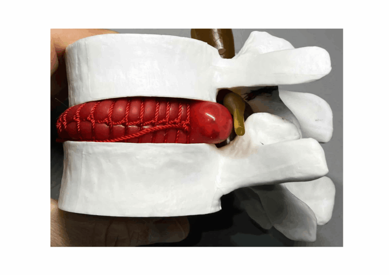 外来説明に動的要素を取り入れた功績 椎間板模型が2回目の破損のアイキャッチ画像