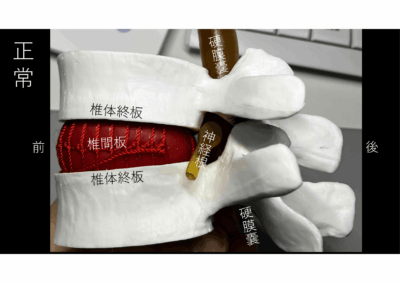 加齢と痛みの増強は比例しない 腰MRIにおける椎間板変性、Modic変化のアイキャッチ画像