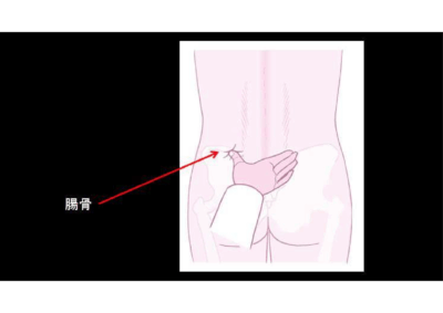 FESSによる両側上殿皮神経剥離術のアイキャッチ画像