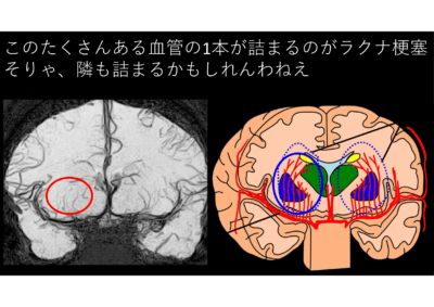 脳梗塞と圧迫骨折は似ている！　実は大きなお化けが隠れていますのアイキャッチ画像