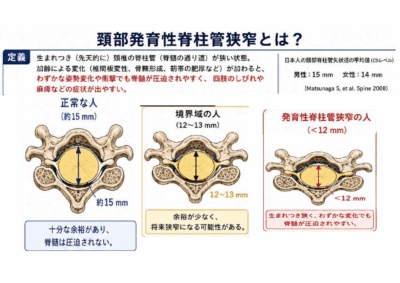 頚の脊髄の入れ物が元々狭い人と広い人がいるという事のアイキャッチ画像