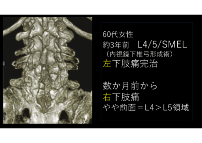 分離症の最終形としての椎間孔狭窄 難しいFESS手術のアイキャッチ画像