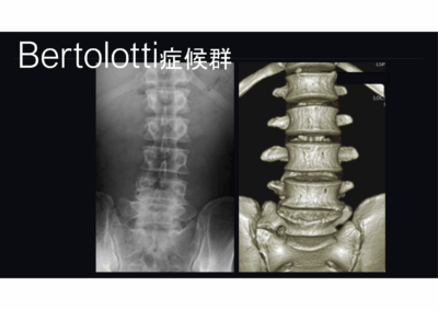 やはりベルトロッティ症候群（Bertolotti syndrome）は腰痛の原因になる　のアイキャッチ画像