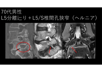 椎間孔狭窄、外側型ヘルニアでは背側除圧をしっかりやってから椎間板にアプローチする外堀をしっかり埋めてから攻めないといけませんのアイキャッチ画像