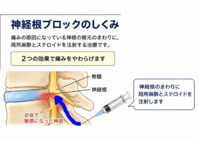 神経根ブロックについて①のアイキャッチ画像