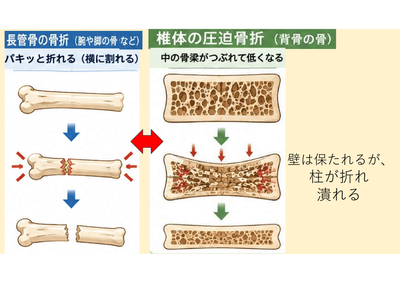 BKPとは 多椎体手術についてのアイキャッチ画像