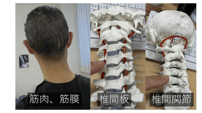 くびの痛みに対する手術適応のアイキャッチ画像