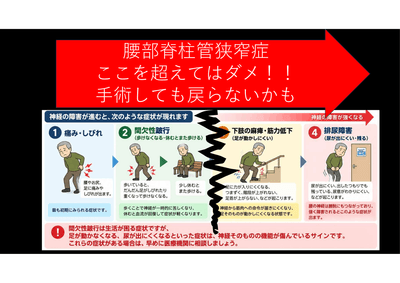 腰部脊柱管狭窄症のヤバ症状のアイキャッチ画像