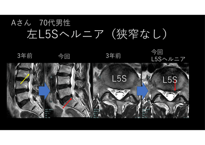 ヘルニアの痛みは炎症なのか、圧迫なのか？のアイキャッチ画像