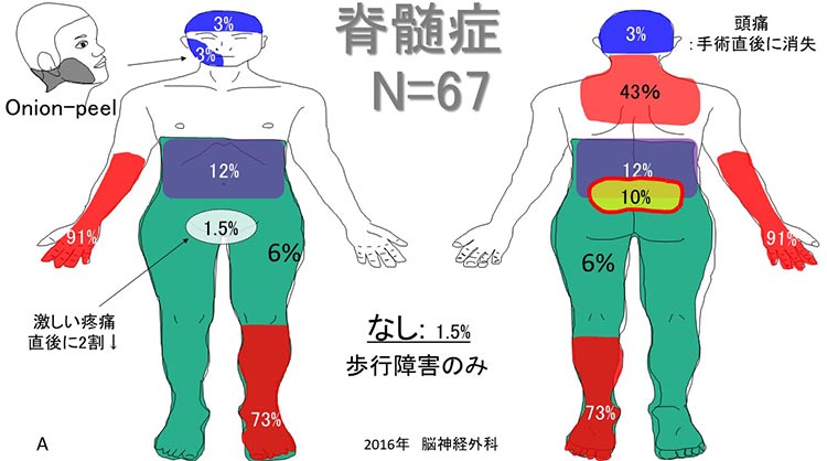 頚椎症性脊髄症・後縦靭帯骨化症